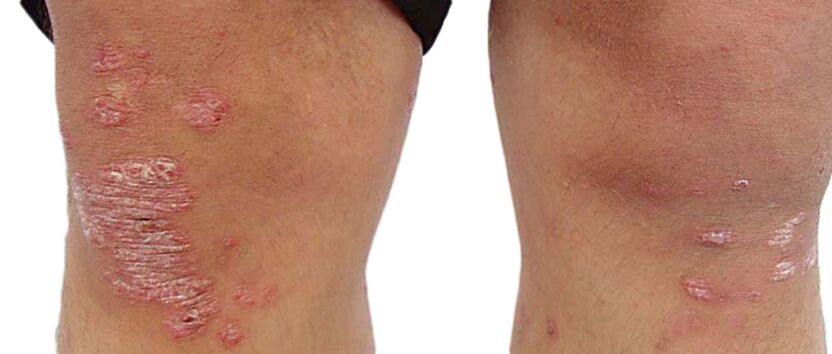Psoriasis is an unpleasant skin disease that requires treatment with the Keraderm cream