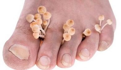 The reasons for the development of the fungus between the toes