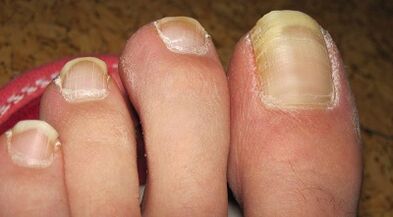 How the fungus on nails manifests