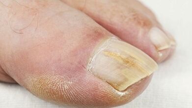 The early stage of fungus development in nails