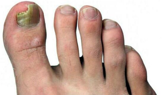 Crushing the nail