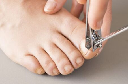 The causes of the fungus in the nails