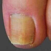yeast lesions on the nail