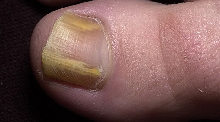 fungal nail infection