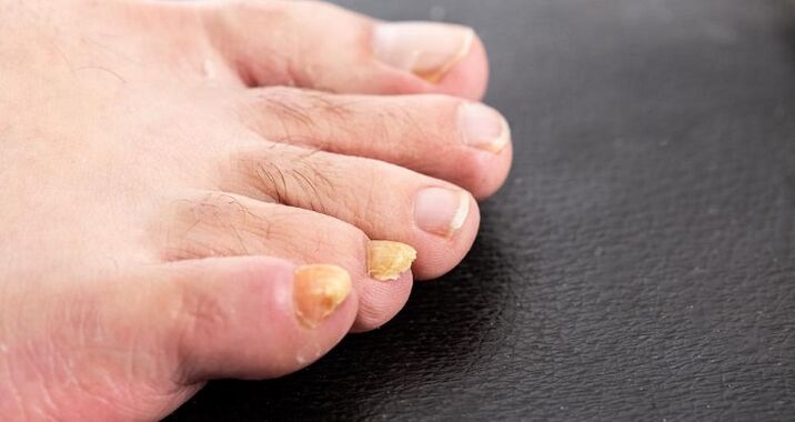 yellowing of nails due to toe fungus