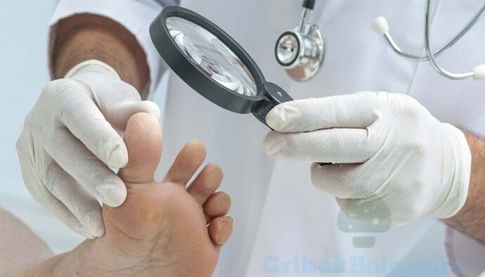 diagnosis of foot fungus by a doctor