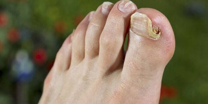 big toe nail fungus