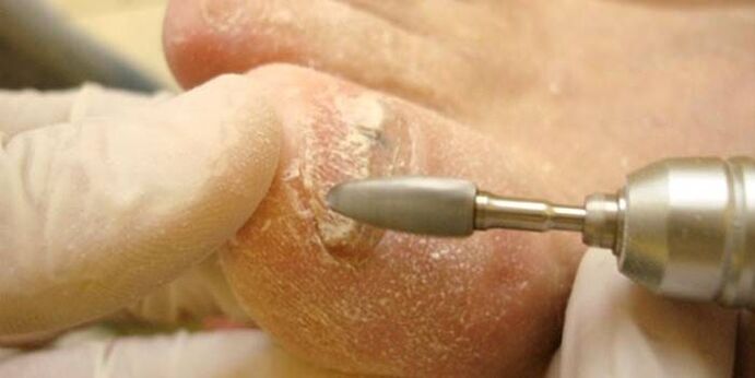 nail fungus removal