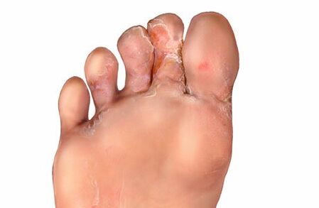 fungus symptoms between toes
