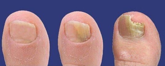 Development of nail fungus