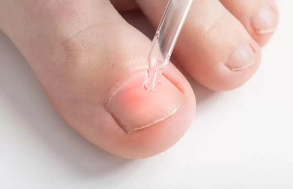 Treatment of onychomycosis with antifungal solution