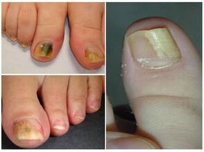 Appearance of toenails with onychomycosis