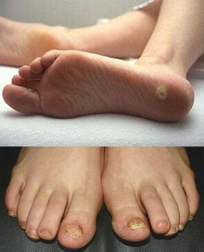 Manifestations of ringworm on the skin and toenails