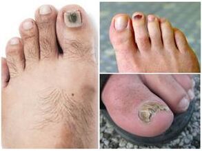 Signs of fungal infection in toenails