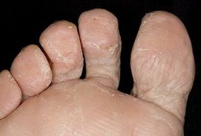 The skin of the feet with fungal infection