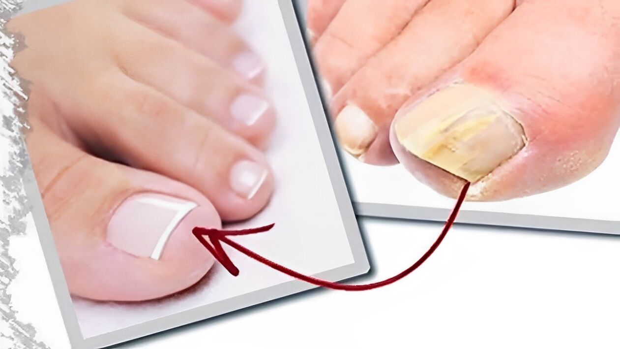 before and after nail fungus treatment