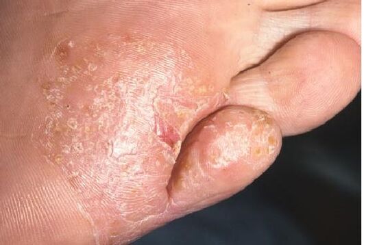 Manifestations of a fungal infection on the skin of the foot
