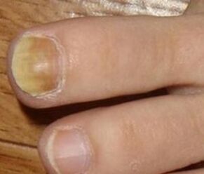 Early stage symptoms of nail fungus