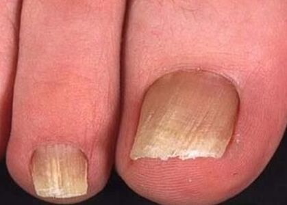Nail fungus on the legs of the early stage